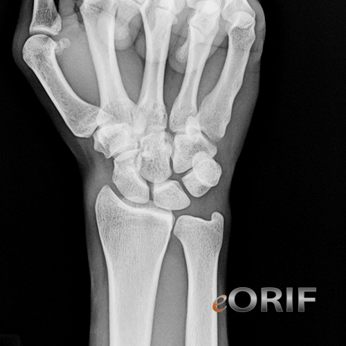 Wrist Xray eORIF